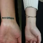 Удаление татуировок и татуажа в Алматы