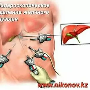 Лапароскопические операции хирург- Никонов