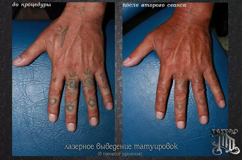 Удаление татуировок и татуажа в Алматы 3