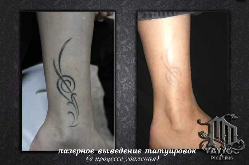 Удаление татуировок и татуажа в Алматы 4