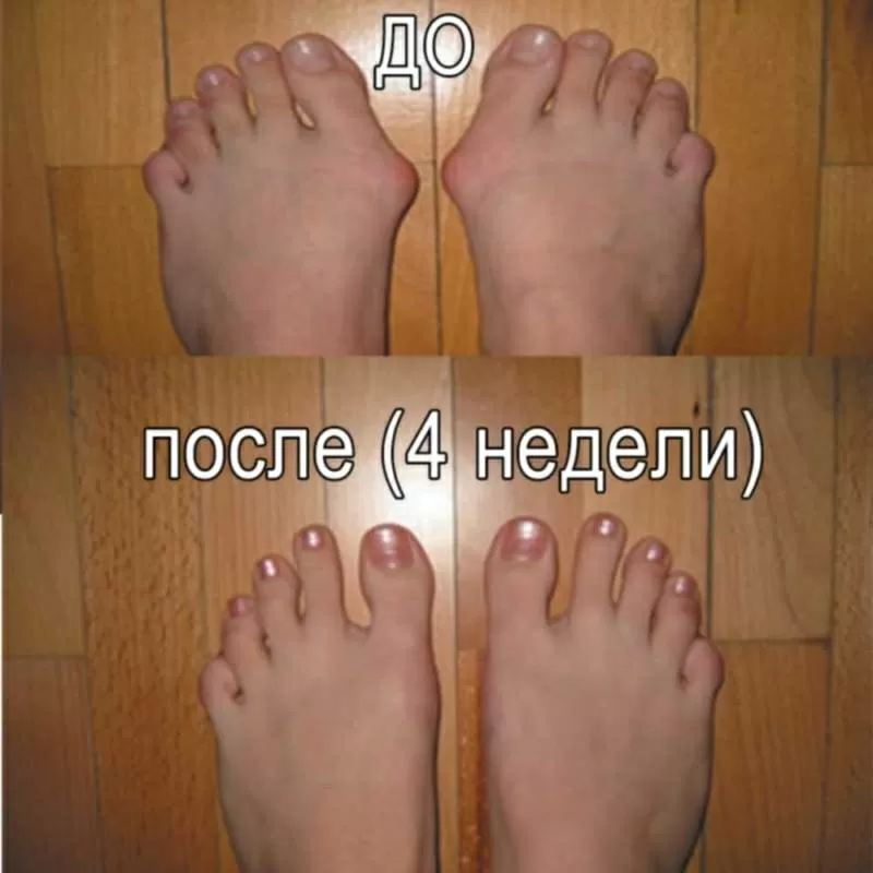 Супер средство от косточки на ноге - Valgus Pro! 3