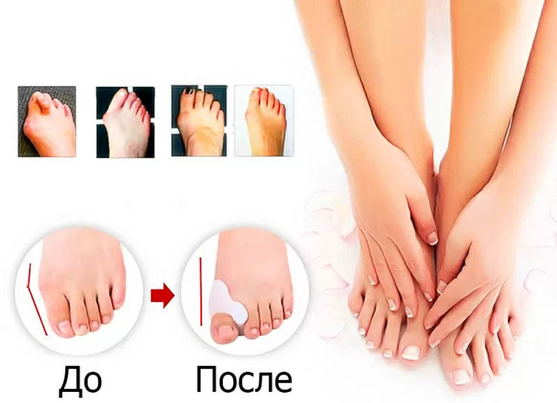 Супер средство от косточки на ноге - Valgus Pro! 4