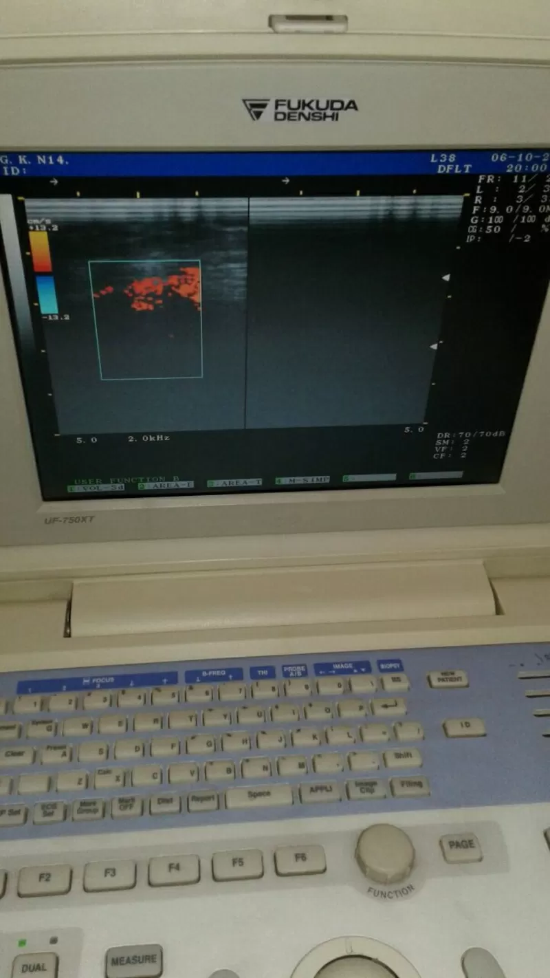 Диагностический портативный УЗИ сканер FUKUDA UF-750XT 3