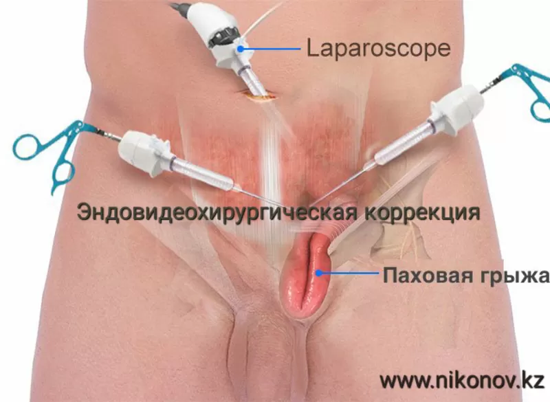 Лапароскопические операции хирург- Никонов 2
